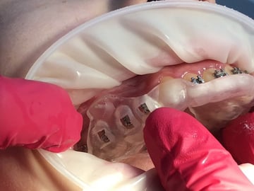 Wydrukowany w 3D przewodnik chirurgiczny pokazujący, gdzie dokładnie mają zostać zainstalowane implanty