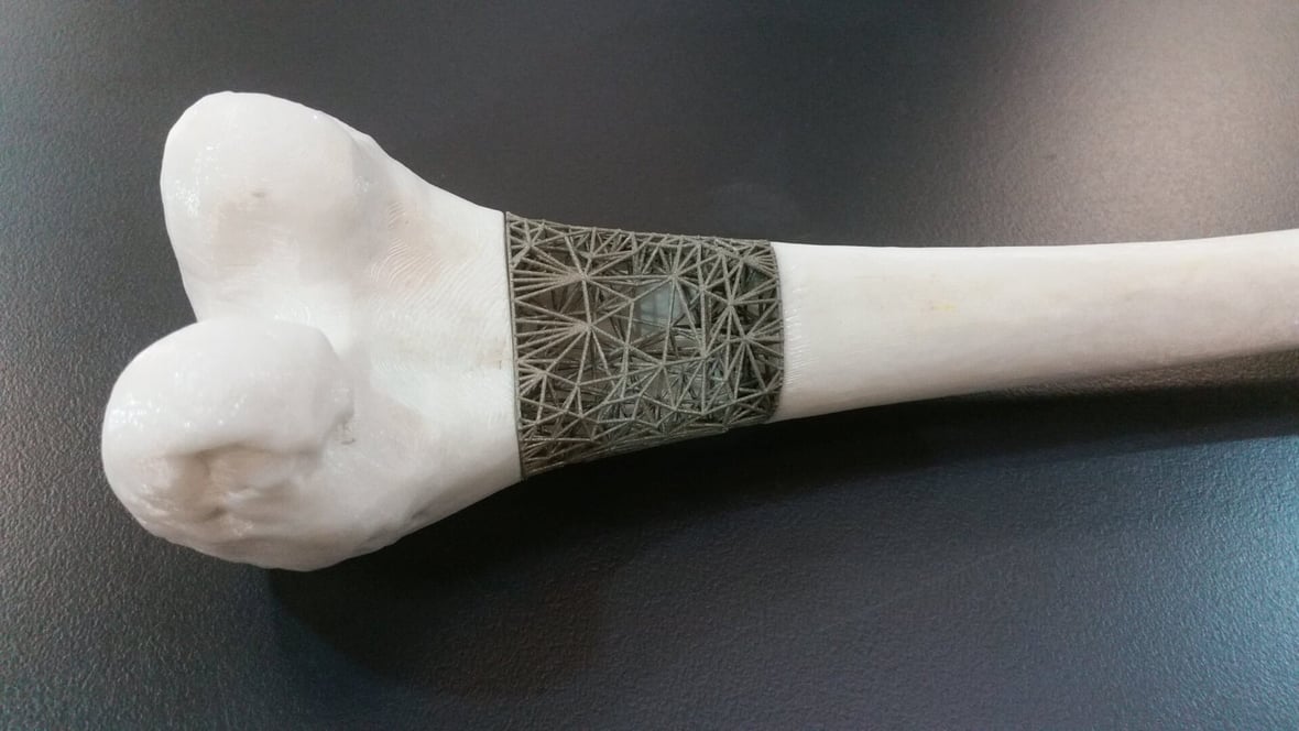 Featured image of Doctors Plan to 3D Print Bone Implants Mid-Surgery