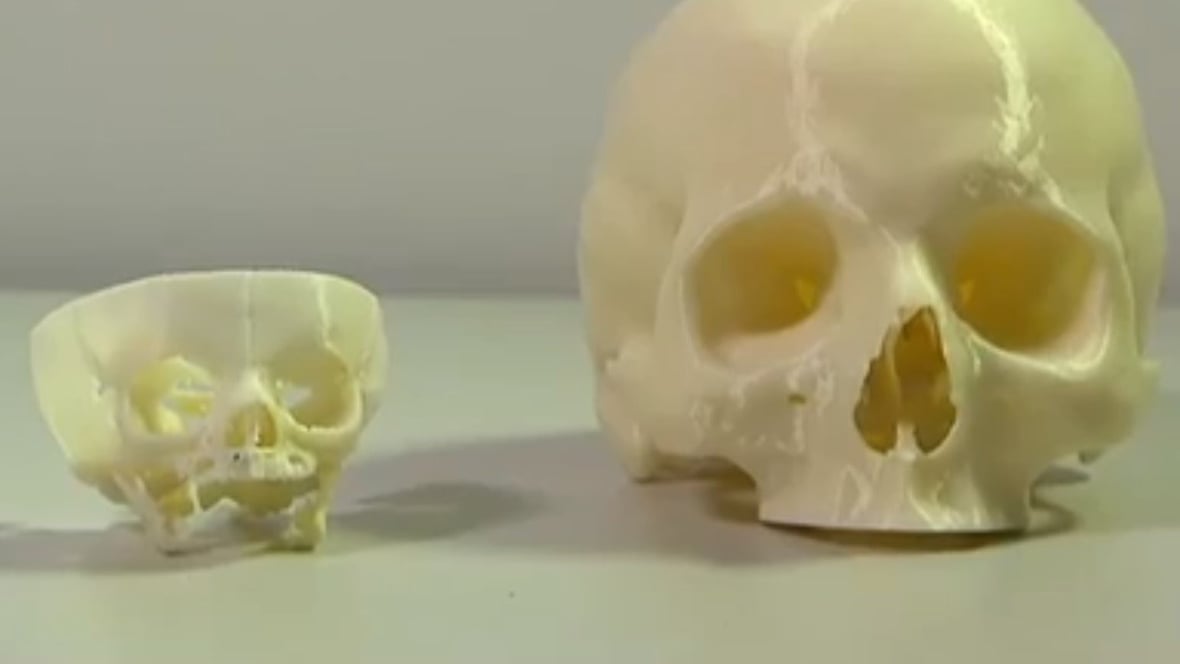 Featured image of 3D Printed Skull Saves Newborn’s Life in Perth