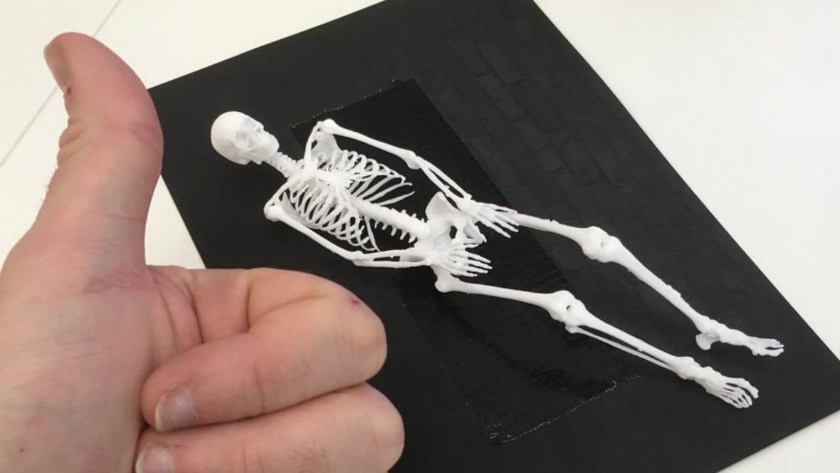 Featured image of Programmer 3D Prints own Skeleton to Help Cope with Cancer