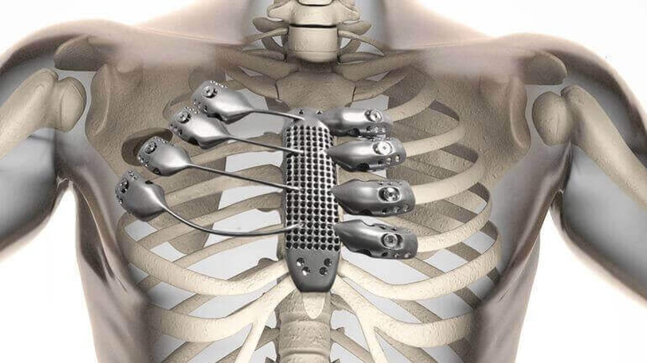 Featured image of World First: Cancer Patient receives 3D Printed Sternum