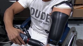 Featured image of Honda Employees 3D Print Prosthetic Arm for Colleague