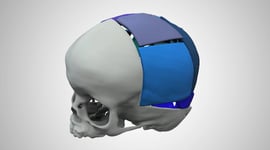 Featured image of 3D Systems Partners With Stryker To Launch Virtual Surgical Planning Service