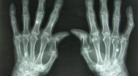 Featured image of 3D Printing Living Tissue Could Heal Damaged Joints and Eliminate Arthritis