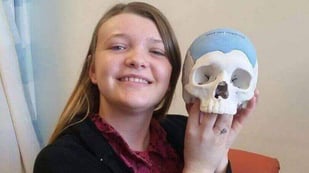 Featured image of Woman Receives 3D Printed Skull Implant After Brain Tumor Removal