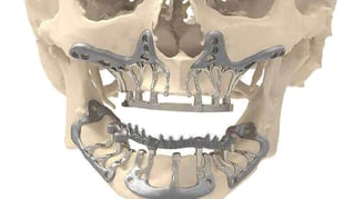 Featured image of CADSkills Develops 3D Printed Titanium Jaw Implant to Reduce Surgical Time