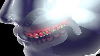 Featured image of 3D Printed Braces with LED Lights and Micro Batteries Save Time and Money