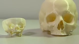 Featured image of 3D Printed Skull Saves Newborn’s Life in Perth