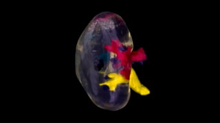 Featured image of Kidney Transplant using Aixal3D Print is Medical First in Northern Ireland