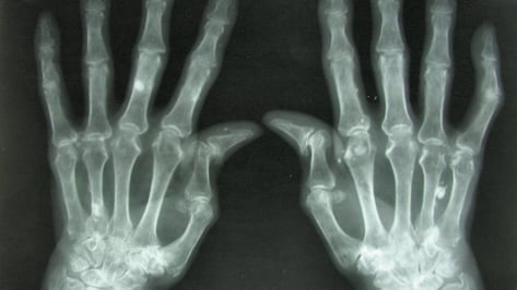 Featured image of 3D Printing Living Tissue Could Heal Damaged Joints and Eliminate Arthritis