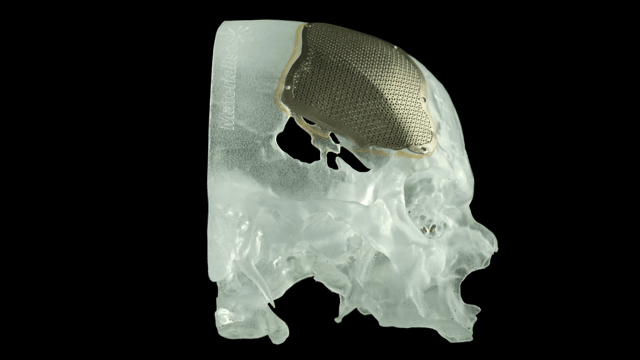 Featured image of Revolutionizing Facial Reconstructive Surgery with 3D Printing