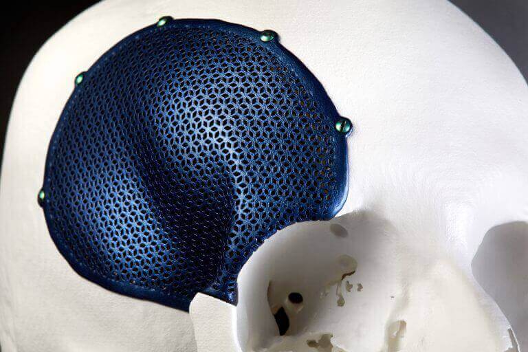 Revolutionizing Facial Reconstructive Surgery with 3D Printing | All3DP