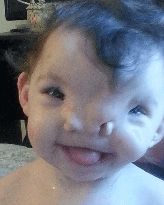 How 3D Printing Reshaped One Toddler’s Face source: MyFoxAtlanta.com)
