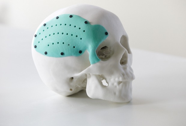 Model of a skull with a 3D printed plate.