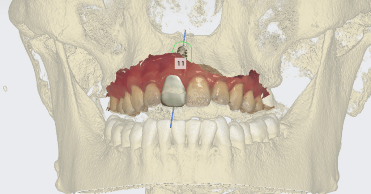 An implant case study using 3D dental scanners.