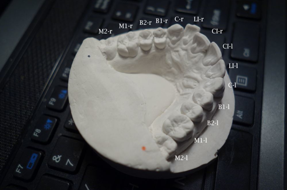 Mold of Amos Dudley's teeth