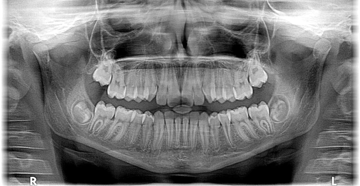 An X-ray image of teeth