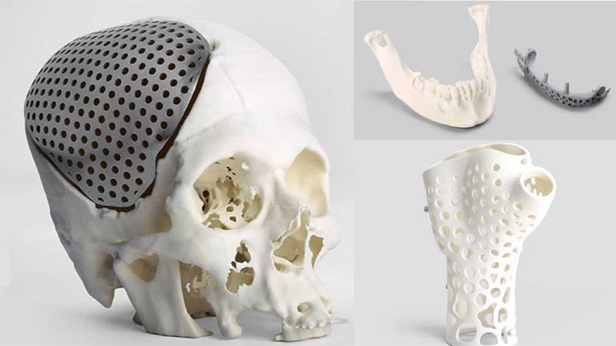 With 3D printing, every implant looks different and can be shaped precisely to the patient’s bone