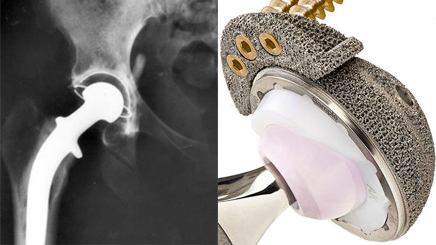 The Acetabular's irregular surface promotes bone adhesion and stimulates cell growth in the patient's hip