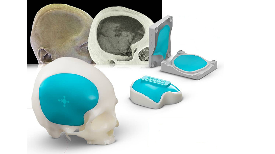 Cranioplasty implants can be previously produced with 3D printed molds