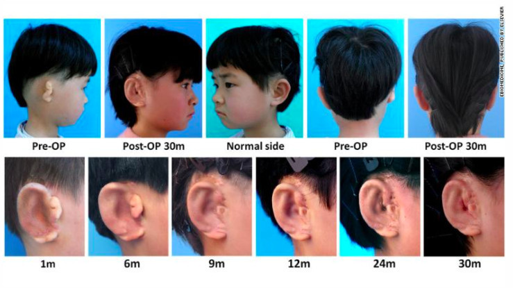 This boy was born with microtia, which a 3D printed ear has corrected