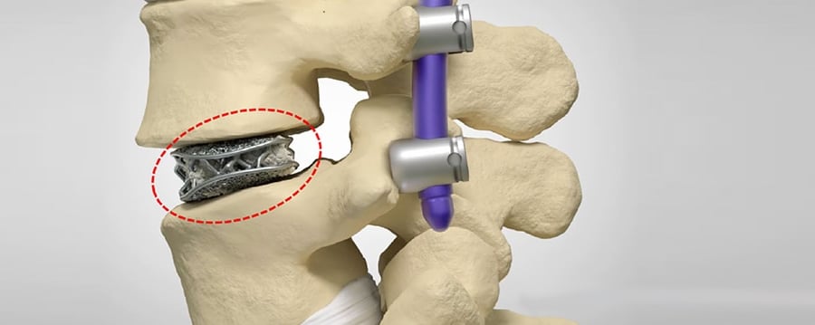 Image of 3D Printing in Orthopedics: Better Knee, Hip & Spine Implants: Additively Manufactured Implants of the Future