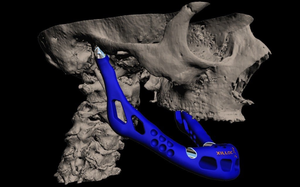 The final design of a patient-specific jaw implant