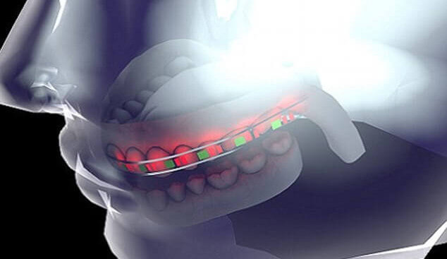 Featured image of 3D Printed Braces with LED Lights and Micro Batteries Save Time and Money