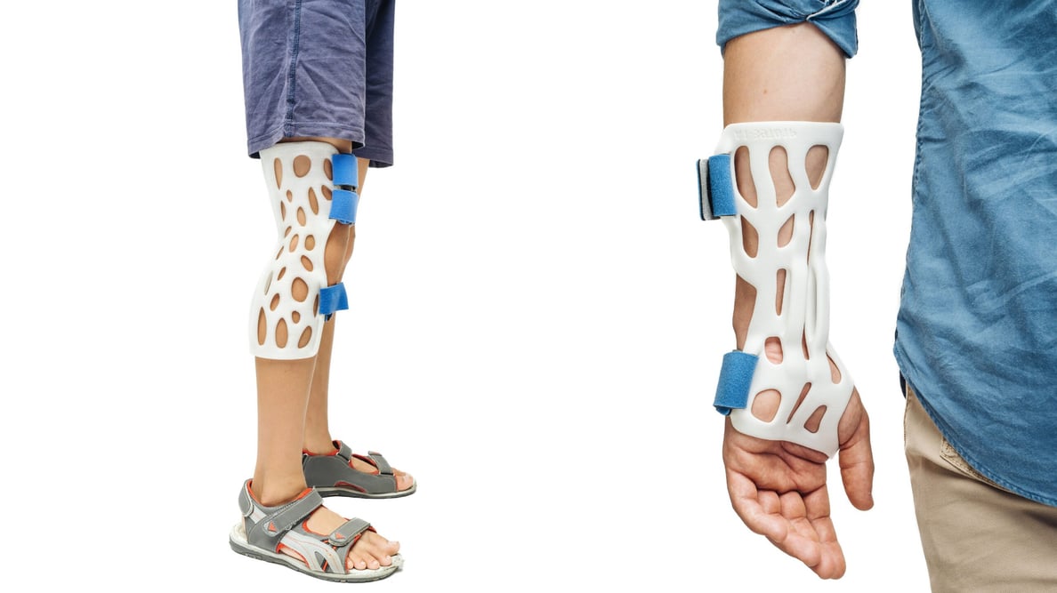 Featured image of 3D Printing Casts, Braces & Orthotics