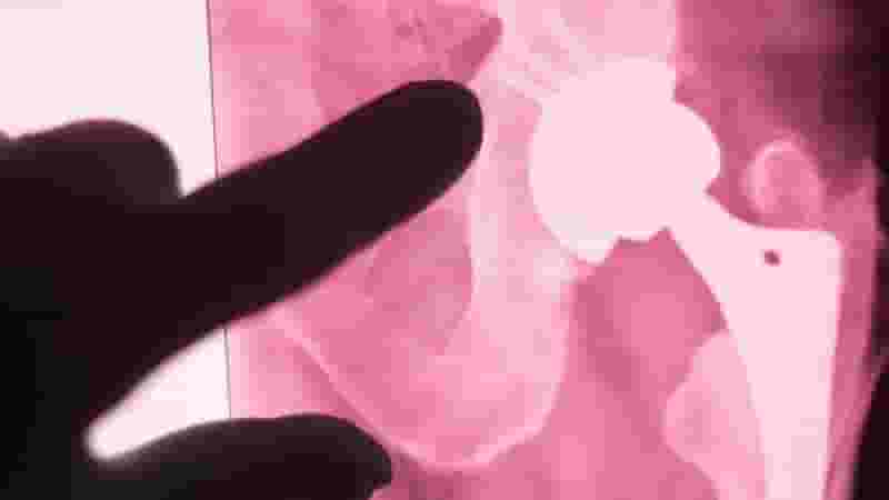 Featured image of 3D Printed Ceramic Implant Fuses With Bone to Repair Broken Limbs