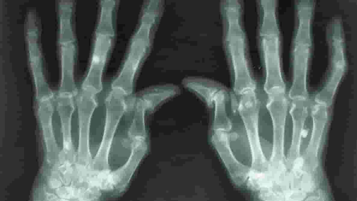 Featured image of 3D Printing Living Tissue Could Heal Damaged Joints and Eliminate Arthritis