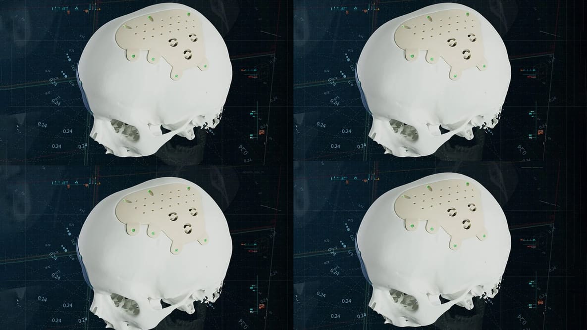 Featured image of Materialise Launches PEEK CMF Implants, Broadening Material Options in Personalized Surgery
