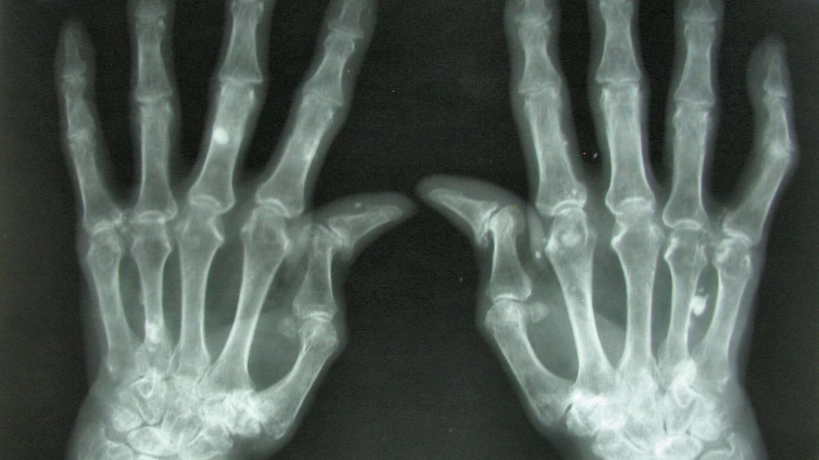 Featured image of 3D Printing Living Tissue Could Heal Damaged Joints and Eliminate Arthritis