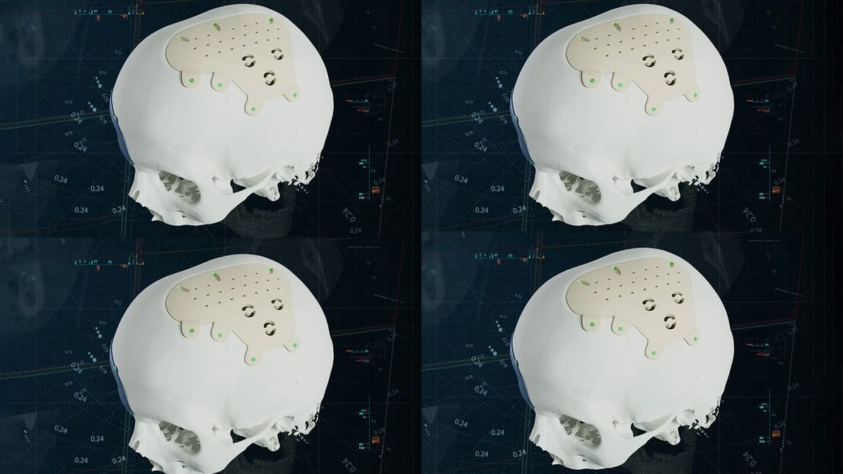 Featured image of Materialise Launches PEEK CMF Implants, Broadening Material Options in Personalized Surgery