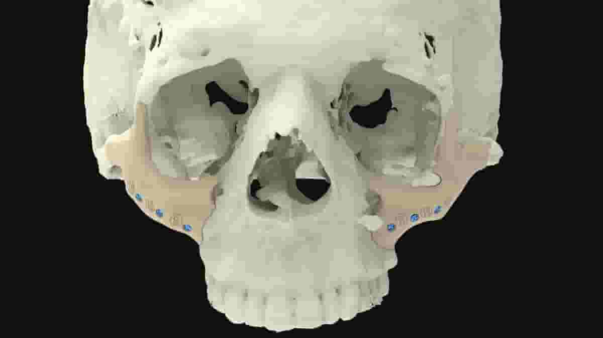 Featured image of 3D Printed Bones: The Most Jaw-Dropping Projects
