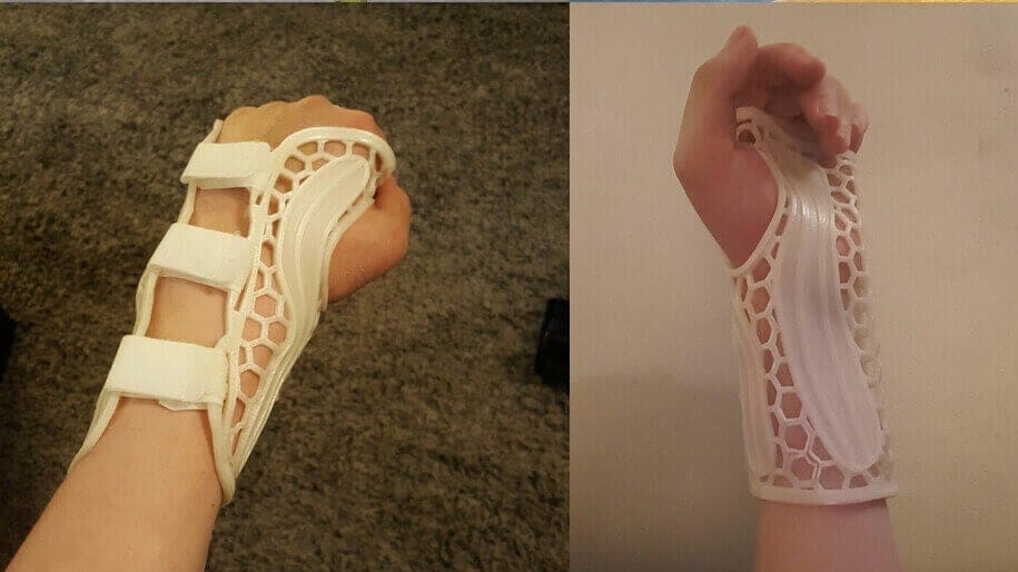 Featured image of How to 3D Print a Lightweight Wrist Brace
