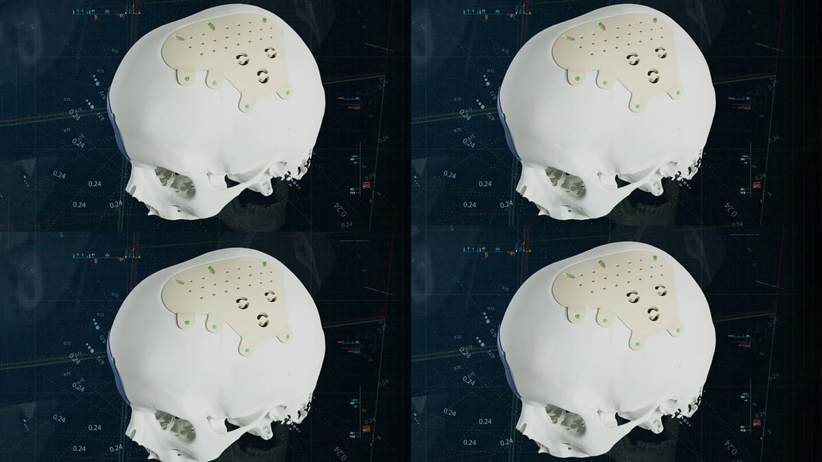 Featured image of Materialise Launches PEEK CMF Implants, Broadening Material Options in Personalized Surgery