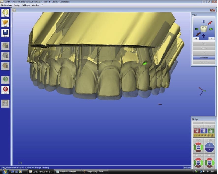 An overlay of provisional virtual model.