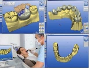Producing fixed restorations with the aid of computer-controlled system.