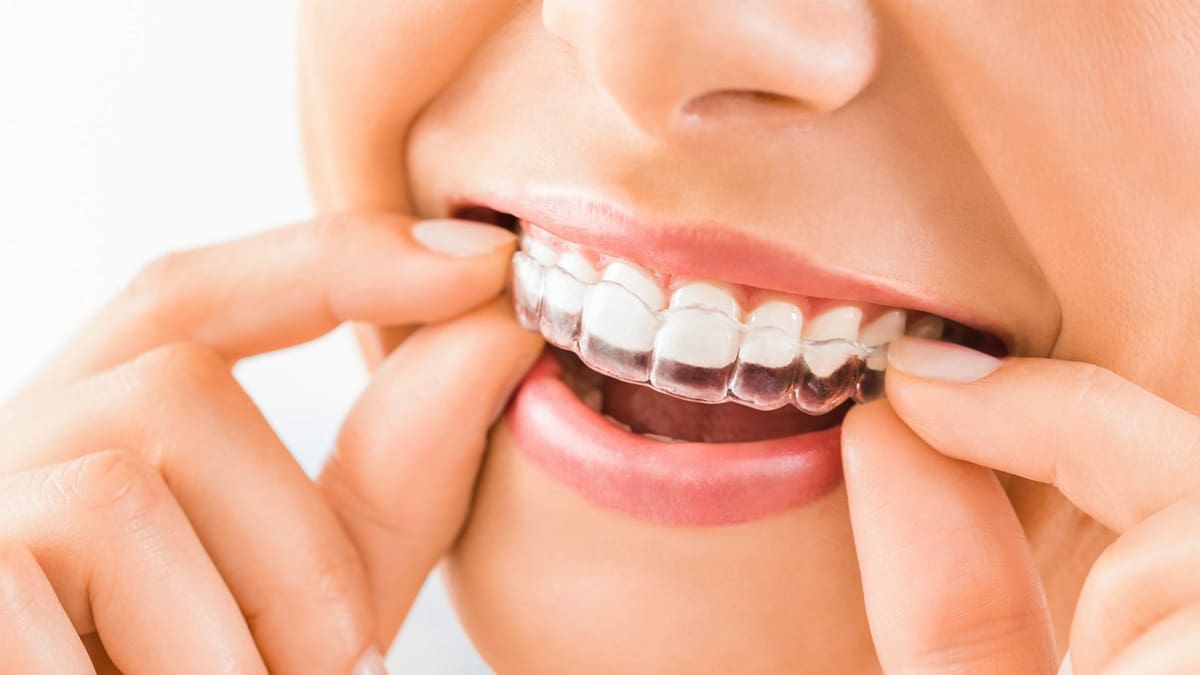 Image of 3D Printing Clear Dental Aligners: How the Dental Aligner Was Born