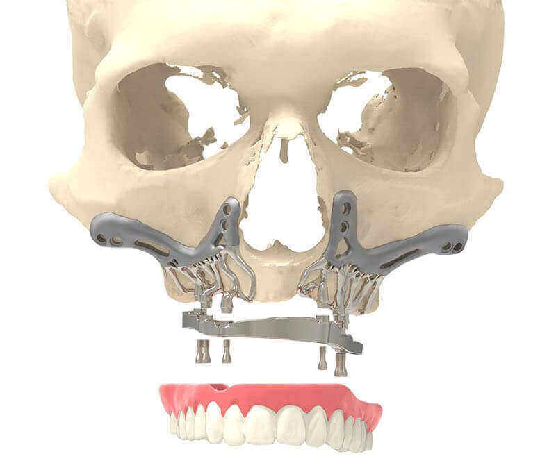 CADSkills Develops 3D Printed Titanium Jaw Implant to Reduce Surgical ...