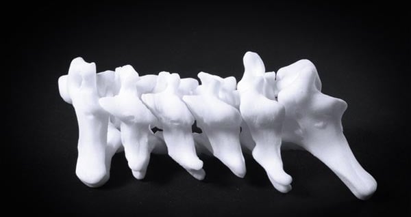 3D Modeling of Scoliosis Offers Non-invasive Diagnostic Options | All3DP