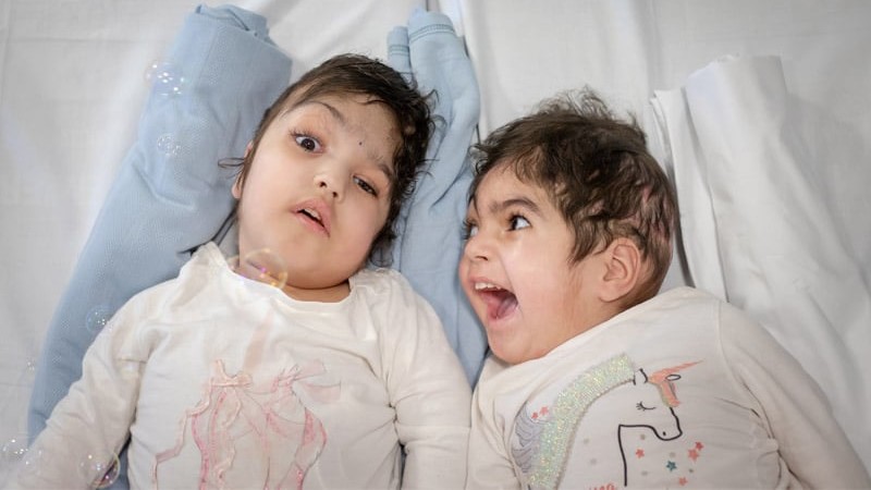 Conjoined Twins Separated With Help Of 3d Printing All3dp